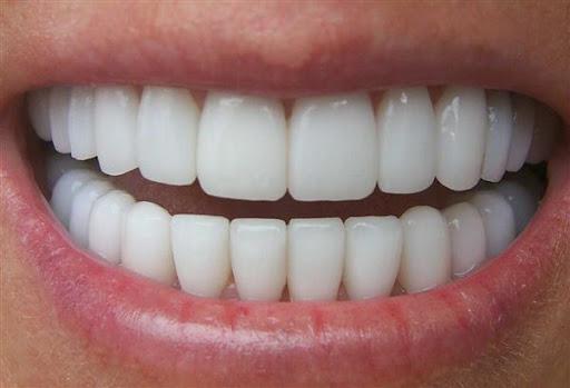 مزایای لمینت دندان