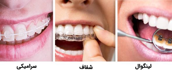 انواع ارتودنسی نامریی ارتودنسی نامریی