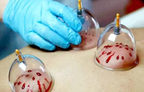 فواید حجامت در درمان بیماری + چه کسانی مجاز به حجامت هستند؟ فواید واقعی حجامت