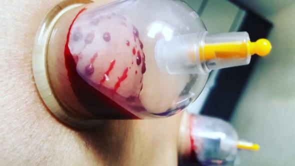 واید حجامت در درمان بیماری + چه کسانی مجاز به حجامت هستند؟ توصیه های قبل از حجامت