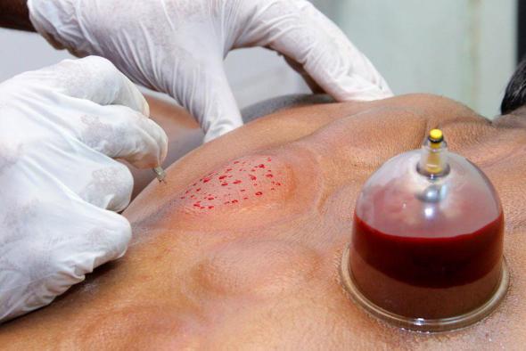 آیا حجامت جوش صورت را درمان میکند؟ فواید حجامت برای پوست حجامت چیست؟