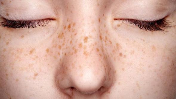 آیا حجامت جوش صورت را درمان میکند؟ فواید حجامت برای پوست فواید حجامت