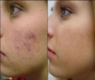 آیا حجامت جوش صورت را درمان میکند؟ فواید حجامت برای پوست تاثیر حجامت بر لکه صورت
