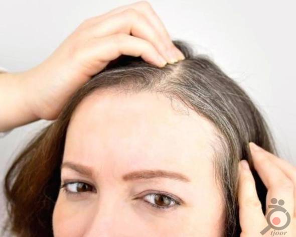 کاشت موی سر زنان