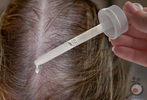 درمان ریزش مو هورمونی