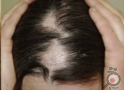 راه های درمان ریزش مو سکه ای