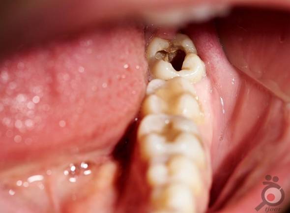 پوسیدگی دندان 