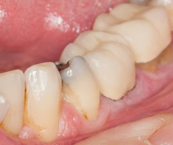 جلوگیری از پوسیدگی دندان