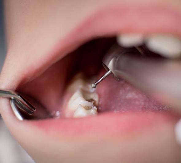 پوسیدگی دندانی