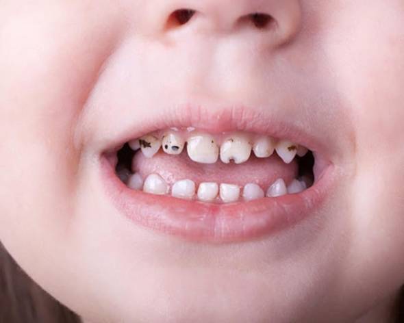 پوسیدگی دندان ها عاملی برای ایجاد بوی بد در دهان کودک