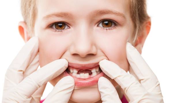 علل خرابی دندان های شیری