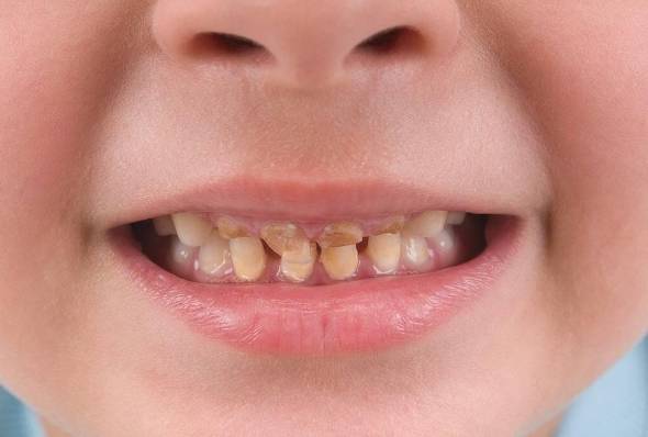 علل خرابی دندان های شیری