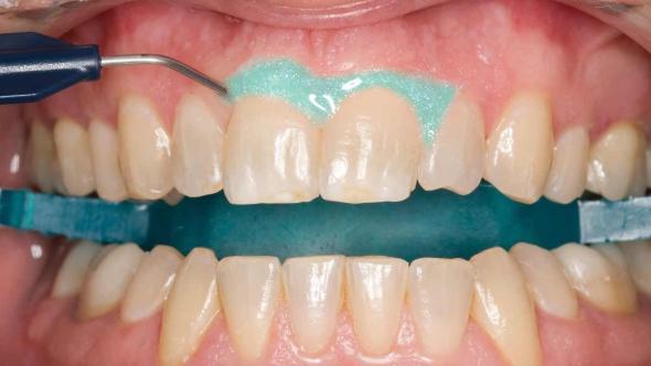 سفید کردن دندان با بلیچینگ