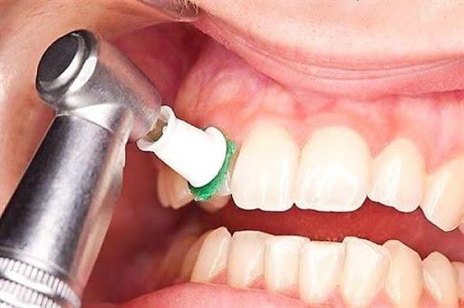 دستگاه جرم گیری دندان