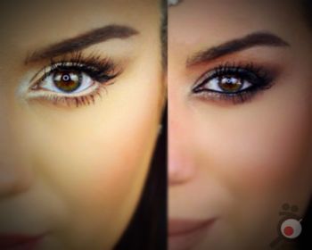 جراحی زیبایی چشم