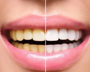 جرم‌گیری دندان