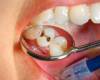 روش های مراقبت از دندان ها در مقابل پوسیدگی