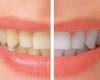 سفید کردن دندان با روش بلیچینگ