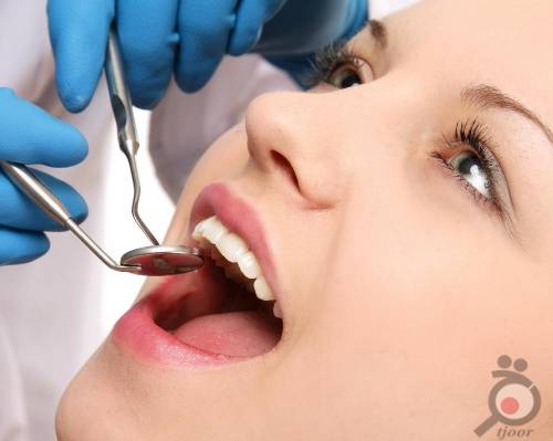 دلایل پوسیدگی دندان عقل
