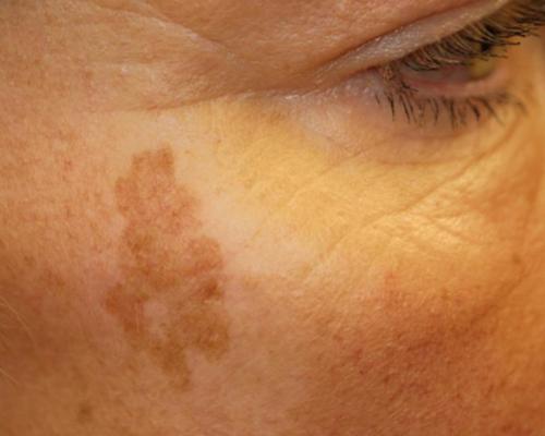 درمان لکه‌های قهوه‌ای پوست صورت