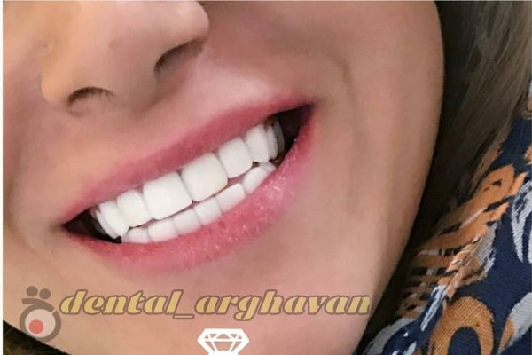 تخفیف ویژه کامپوزیت