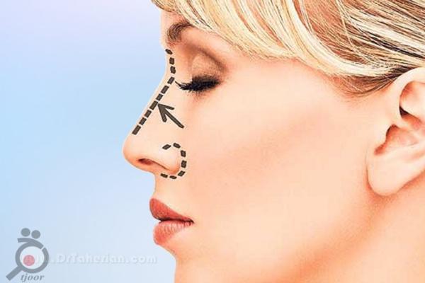 تخفیف ویژه فرمدهی بینی