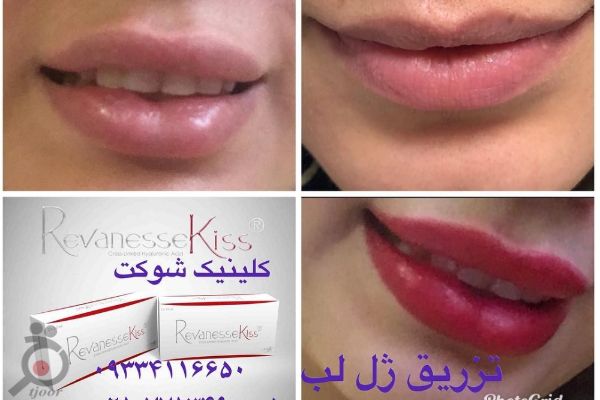 جشنواره تخفیف هایفوتراپی جشنواره تخفیف هایفوتراپی