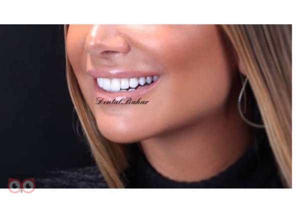 تخفیف ویژه کامپوزیت