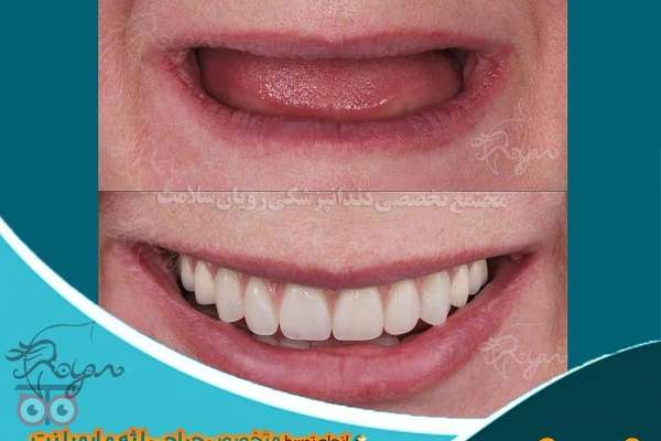 تخفیف ویژه ایمپلنت دندان