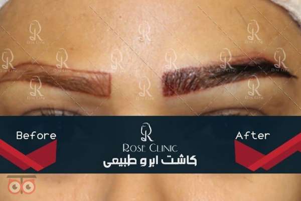 تخفیف ویژه کاشت ابرو تخفیف ویژه کاشت ابرو