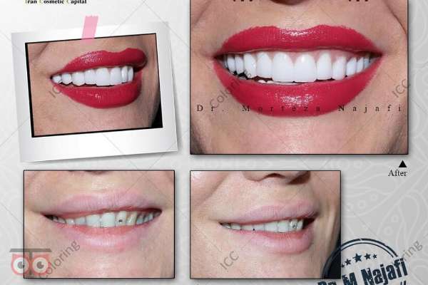 تخفیف ویژه ایمپلنت