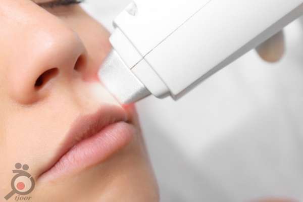 تخفیف ویژه لیزر