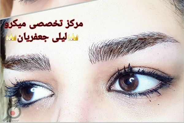 تخفیف میکروپیگمنتیشن