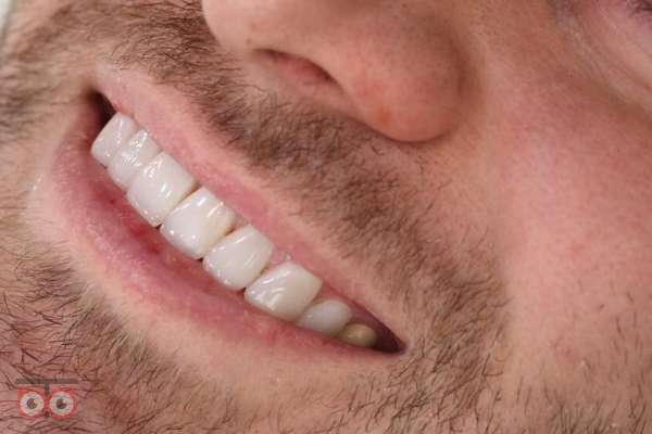 تخفیف کامپوزیت هر دو فک