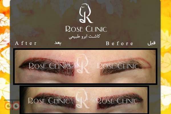 تخفیف کاشت ابرو