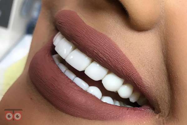 تخفیف کامپوزیت ونیر دندانپزشکی ارغوان تخفیف کامپوزیت ونیر دندانپزشکی ارغوان