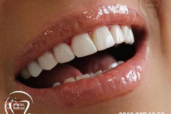 تخفیف ویژه کامپوزیت