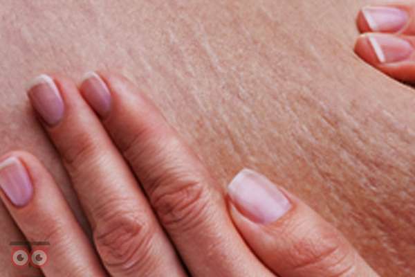 رفع سلولیت و ناهمواری های بدن