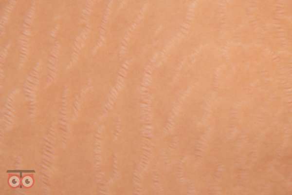 رفع ترک های پوستی با تخفیف ویژه