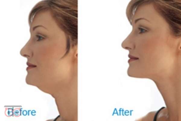 لیفت غبغب با هایفوتراپی