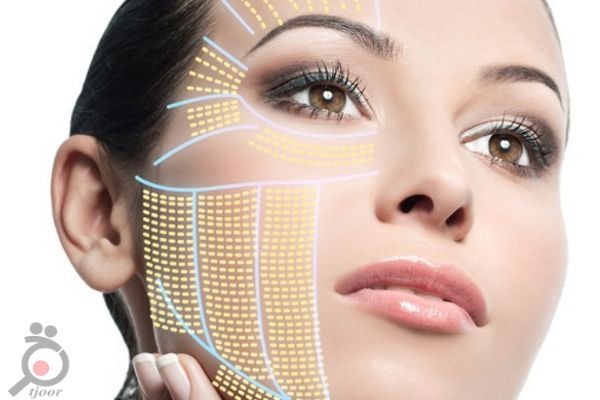 تخفیف ویژه هایفوتراپی تخفیف ویژه هایفوتراپی