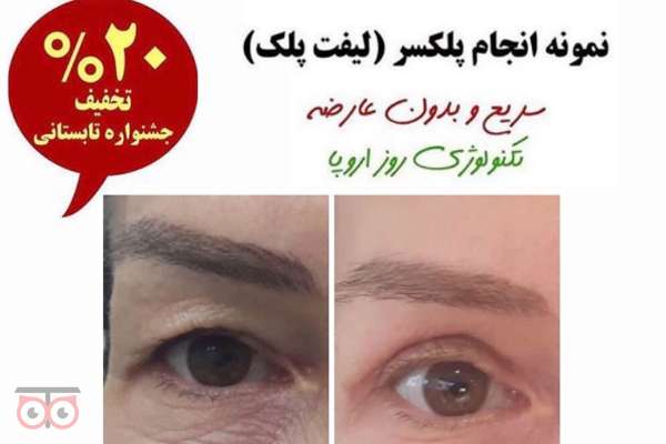 تخفیف ویژه پلکسر (لیفت پلک)