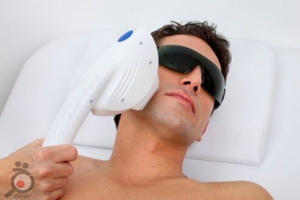 تخفیف ویژه لیزر موهای زائد مخصوص آقایان