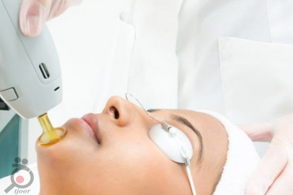 تخفیف ویژه لیزر