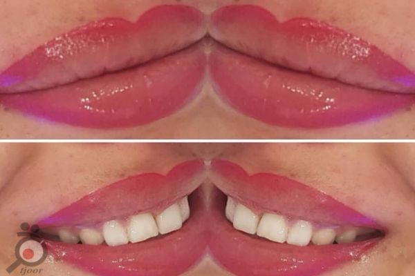 تخفیف ویژه میکروپیگمنتیشن