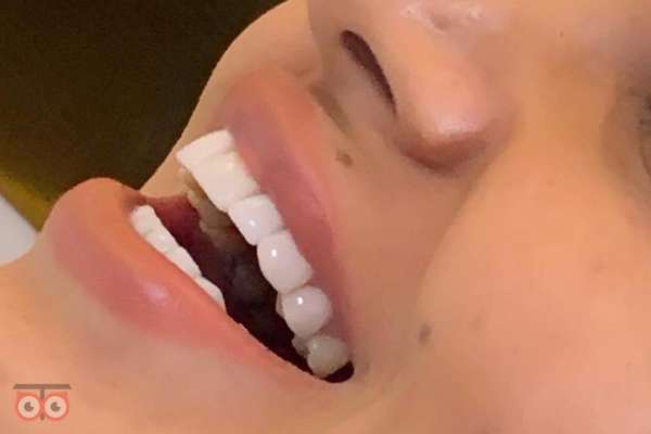 تخفیف ویژه کامپوزیت دندان