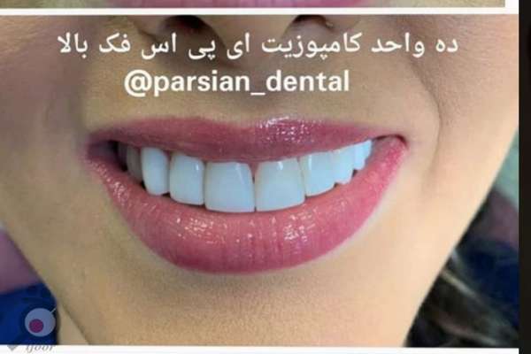 تخفیف کامپوزیت دندان ها