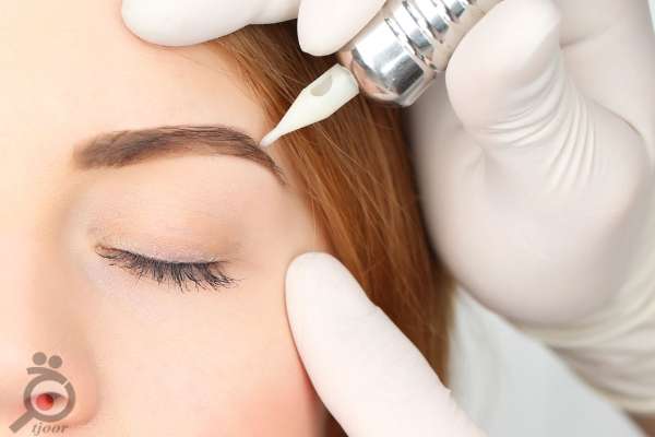 تخفیف خدمات میکروبلیدینگ