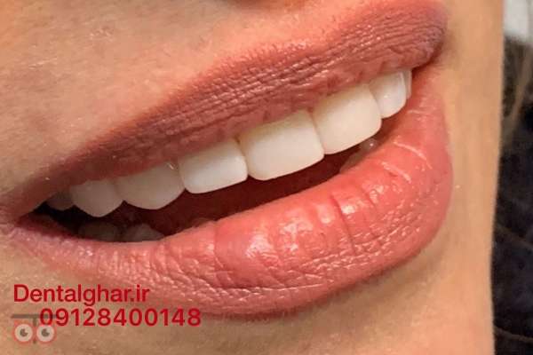 تخفیف ویژه کامپوزیت دندان