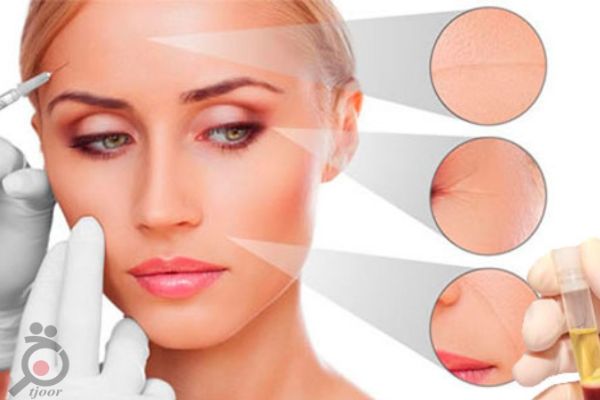 تخفیف ویژه بوتاکس تخفیف ویژه بوتاکس